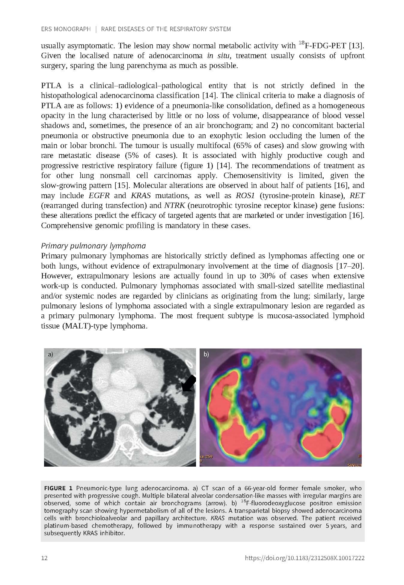 Rare Diseases of the Respiratory System