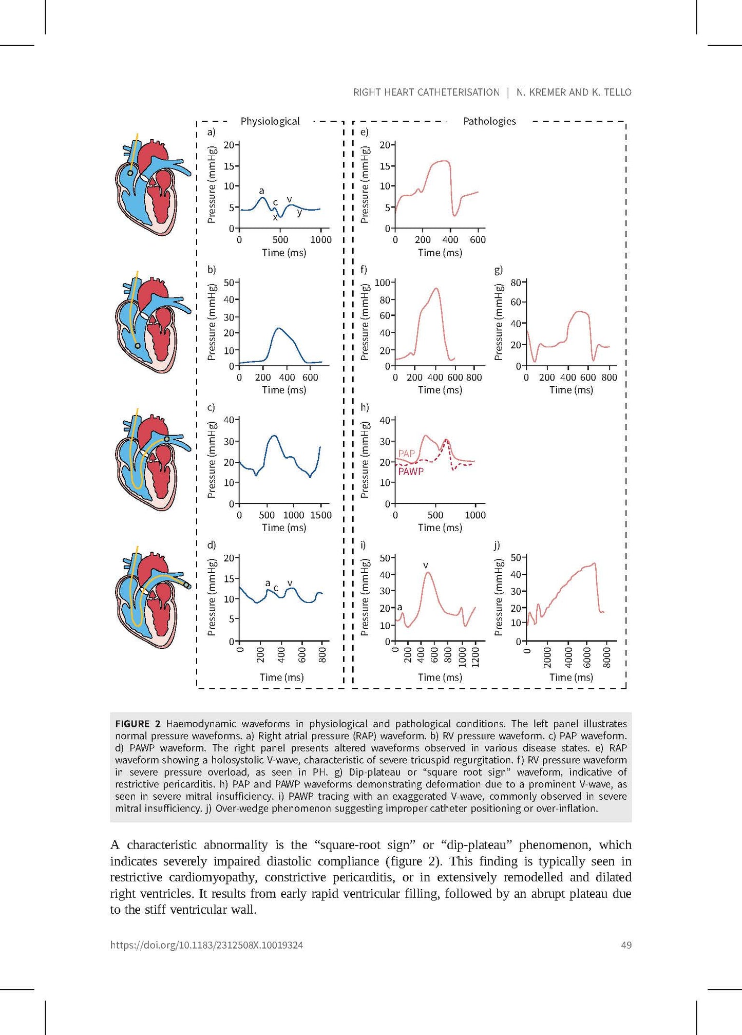 Pulmonary Hypertension