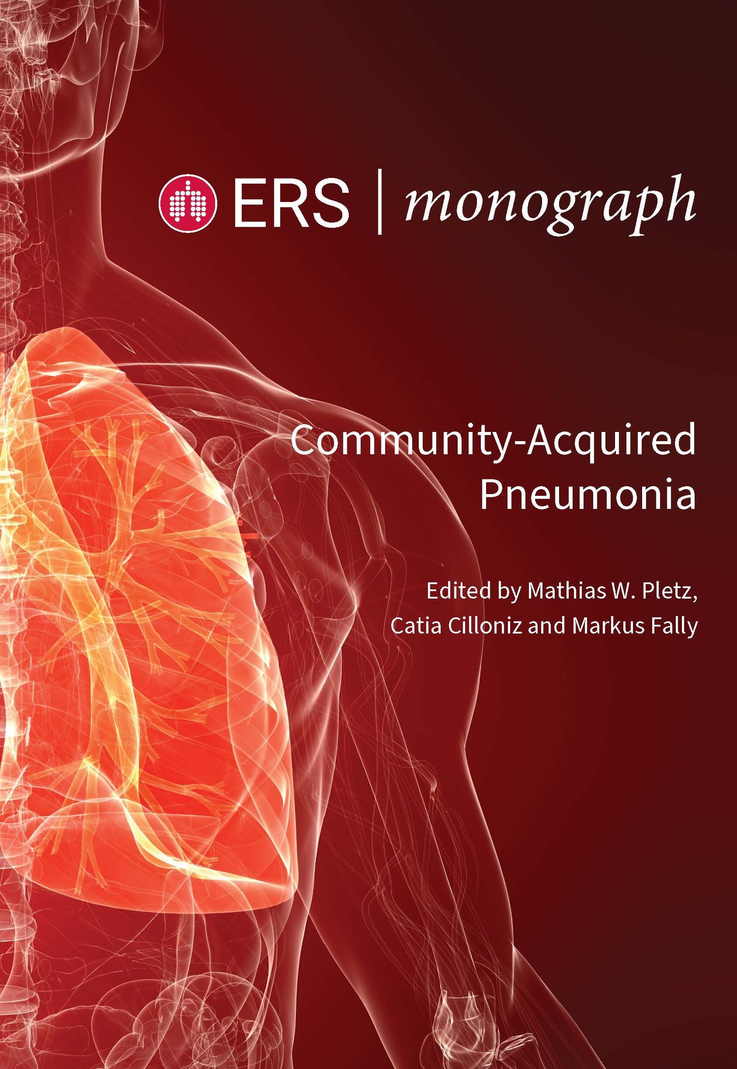 Community-Acquired Pneumonia