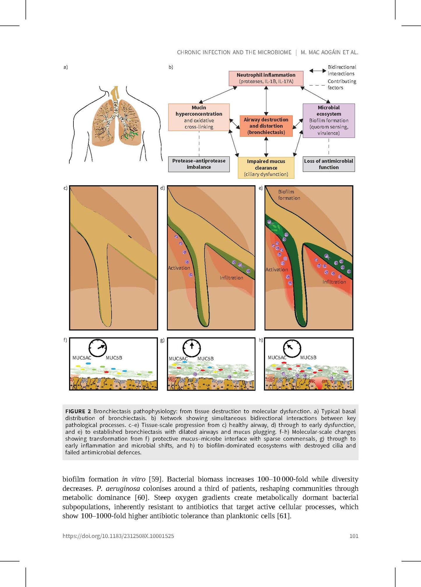 Bronchiectasis