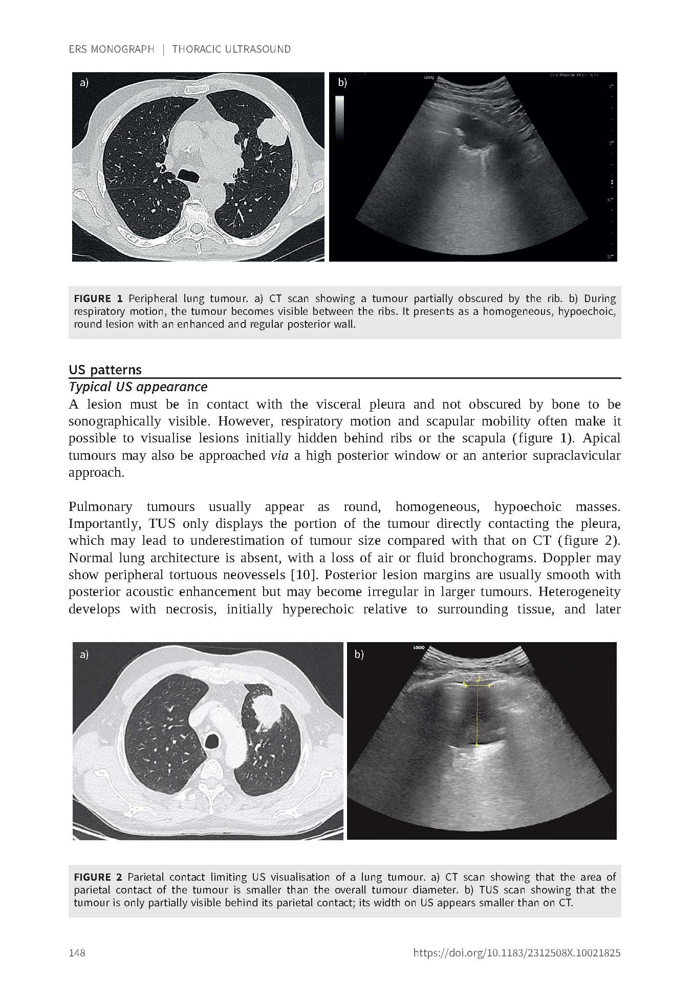 Thoracic Ultrasound